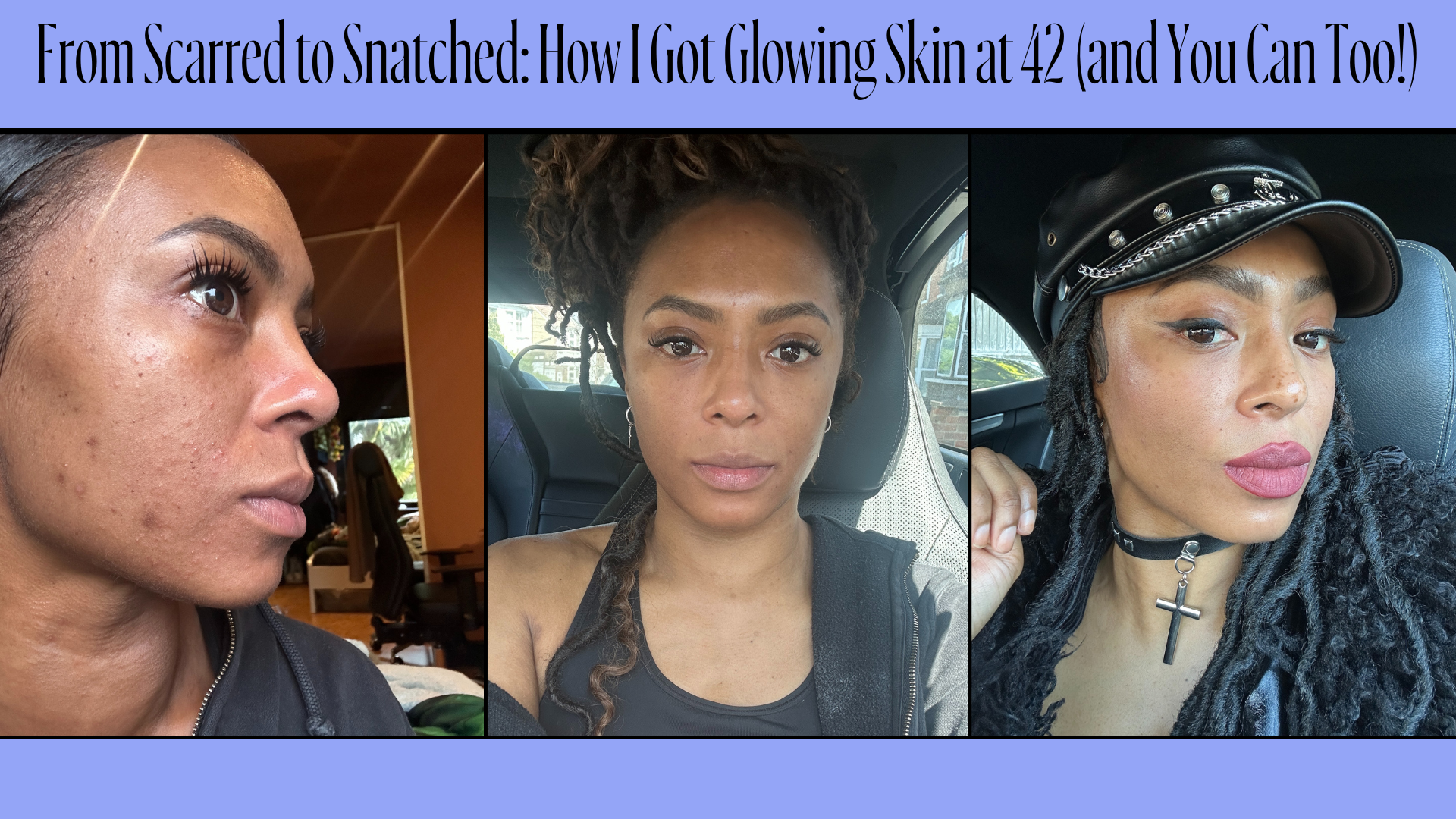 From Scarred to Snatched: How I Got Glowing Skin at 42 (and You Can Too!)